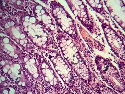 Illinois food poisoning attorney